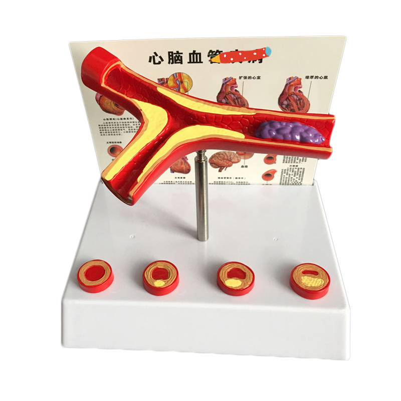 Medical Lab Supplies - 50 배 확대 인간 혈관, 아테롬성